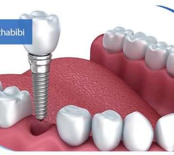 متخصص-ایمپلنت-در-تهران | دکتر-بهروز-حبیبی