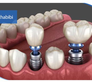متخصص-ایمپلنت-در-تهران | دکتر-بهروز-حبیبی