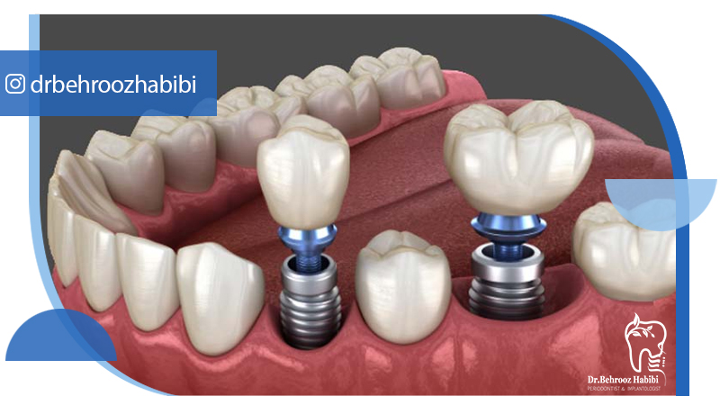متخصص-ایمپلنت-در-تهران | دکتر-بهروز-حبیبی