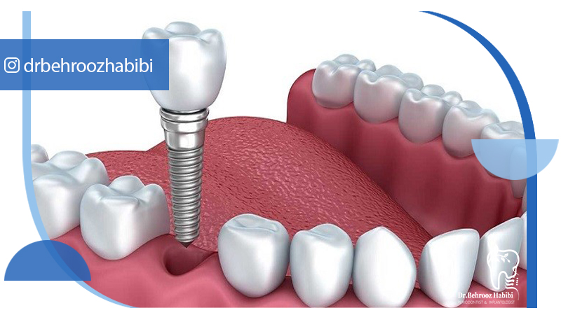 متخصص-ایمپلنت-در-تهران | دکتر-بهروز-حبیبی