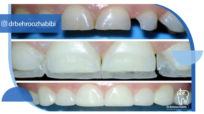 دکتر بهروز حبیبی - متخصص ایمپلنت - جراحی لثه زعفراینه - متخصص ایمپلنت در تهران