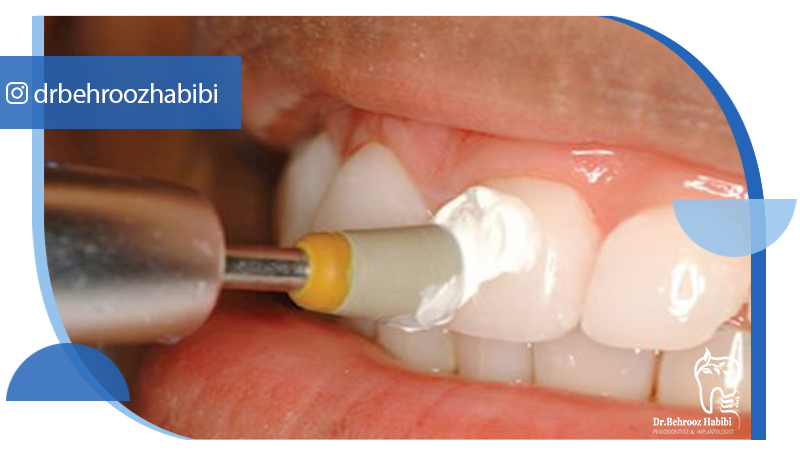 دکتر بهروز حبیبی - متخصص ایمپلنت - جراحی لثه زعفراینه - متخصص ایمپلنت در تهران