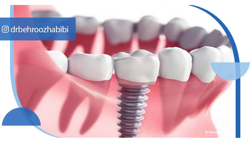 دکتر بهروز حبیبی - متخصص ایمپلنت - جراحی لثه زعفراینه - متخصص ایمپلنت در تهران