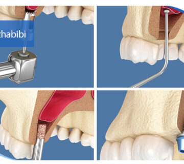 دکتر بهروز حبیبی - متخصص ایمپلنت - جراحی لثه زعفراینه - متخصص ایمپلنت در تهران