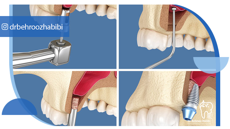 دکتر بهروز حبیبی - متخصص ایمپلنت - جراحی لثه زعفراینه - متخصص ایمپلنت در تهران