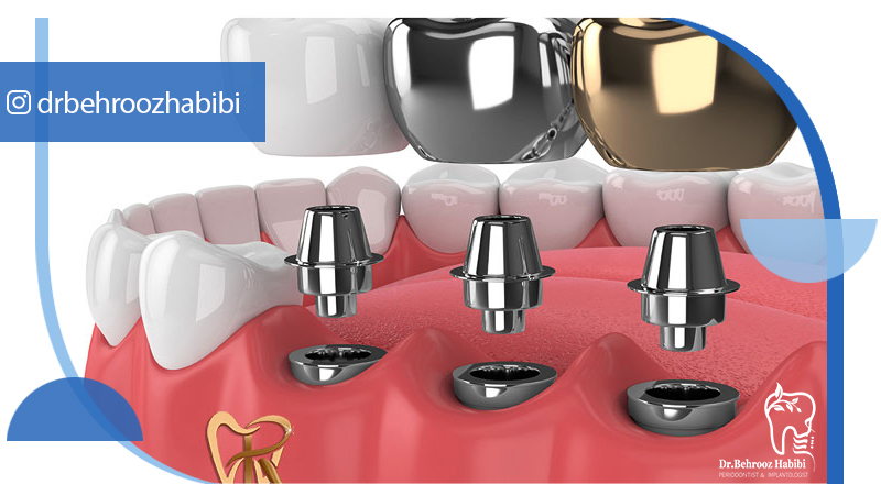 دکتر بهروز حبیبی - متخصص ایمپلنت - جراحی لثه زعفراینه - متخصص ایمپلنت در تهران