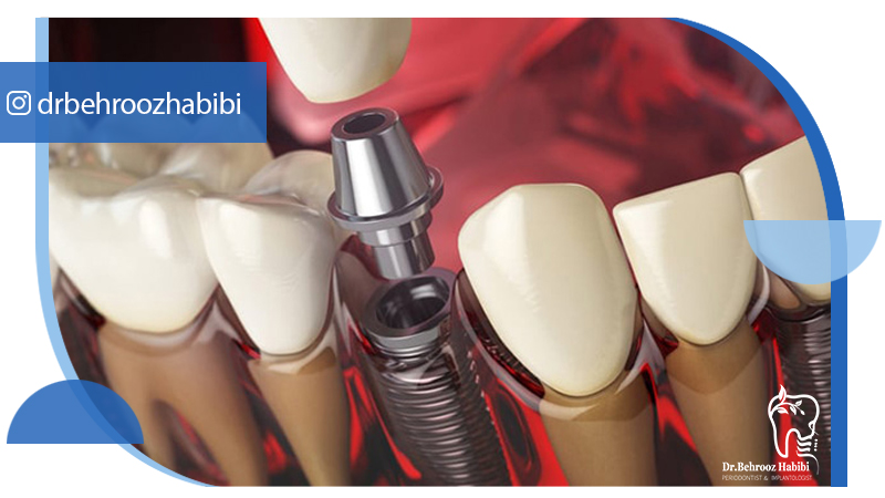 دکتر بهروز حبیبی - متخصص ایمپلنت - جراحی لثه زعفراینه - متخصص ایمپلنت در تهران