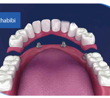 دکتر بهروز حبیبی - متخصص ایمپلنت - جراحی لثه زعفراینه - متخصص ایمپلنت در تهران