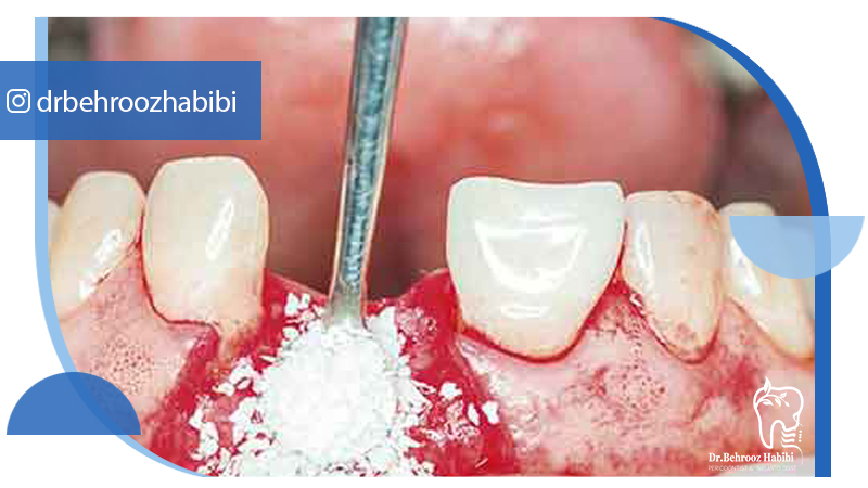 دکتر بهروز حبیبی - متخصص ایمپلنت - جراحی لثه زعفراینه - متخصص ایمپلنت در تهران