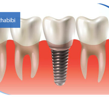 دکتر بهروز حبیبی - متخصص ایمپلنت - جراحی لثه زعفراینه - متخصص ایمپلنت در تهران