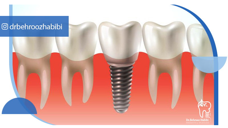 دکتر بهروز حبیبی - متخصص ایمپلنت - جراحی لثه زعفراینه - متخصص ایمپلنت در تهران