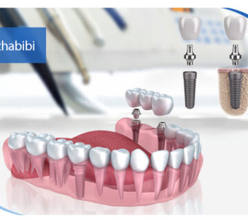 بهترین متخصص ایمپلنت در تهران