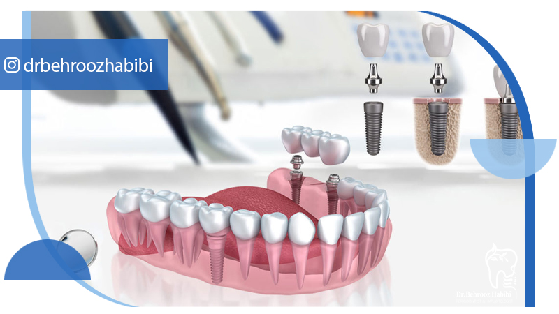 بهترین متخصص ایمپلنت در تهران