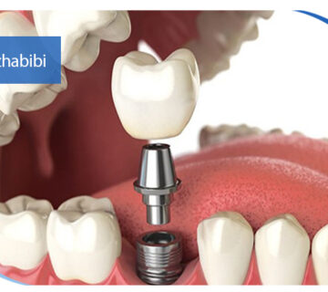 متخصص ایمپلنت در تهران | دکتر بهروز حبیبی