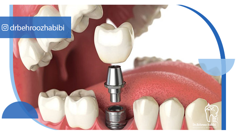 متخصص ایمپلنت در تهران | دکتر بهروز حبیبی