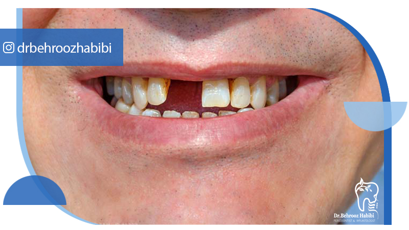 بهترین دکتر متخصص ایمپلنت در تهران | دکتر بهروز حبیبی