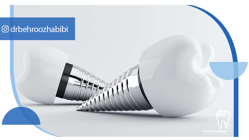 متخصص ایمپلنت تهران | بهترین متخصص ایمپلنت در زعفرانیه تهران