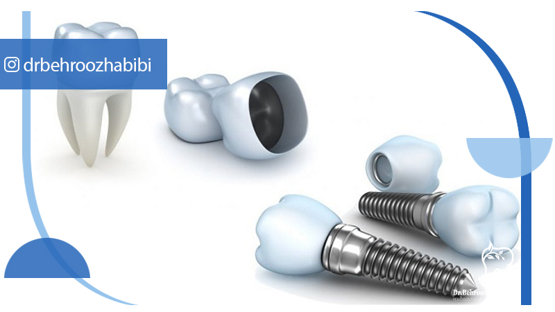 متخصص ایمپلنت تهران | بهترین متخصص ایمپلنت در زعفرانیه تهران