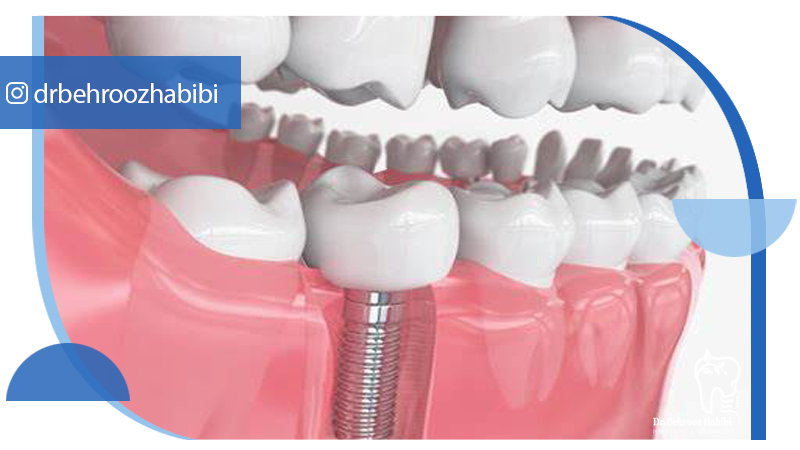 متخصص ایمپلنت تهران | بهترین متخصص ایمپلنت در زعفرانیه تهران