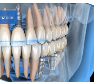 متخصص ایمپلنت تهران | بهترین متخصص ایمپلنت در زعفرانیه تهران