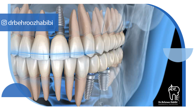 متخصص ایمپلنت تهران | بهترین متخصص ایمپلنت در زعفرانیه تهران