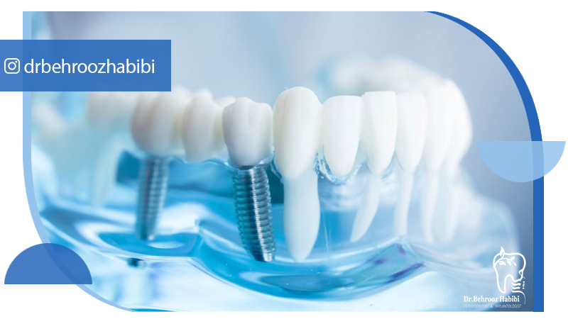 متخصص ایمپلنت تهران | بهترین متخصص ایمپلنت در زعفرانیه تهران