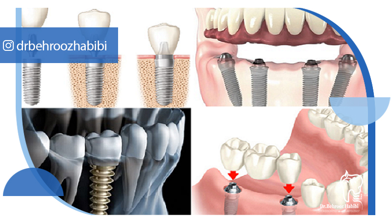 بهترین دکتر ایمپلنت در تهران | دکتر بهروز حبیبی