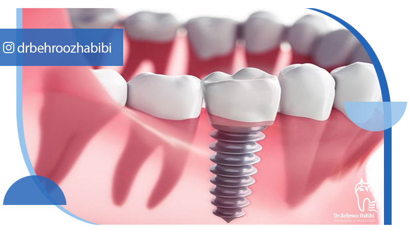 بهترین دکتر ایمپلنت در تهران | دکتر بهروز حبیبی
