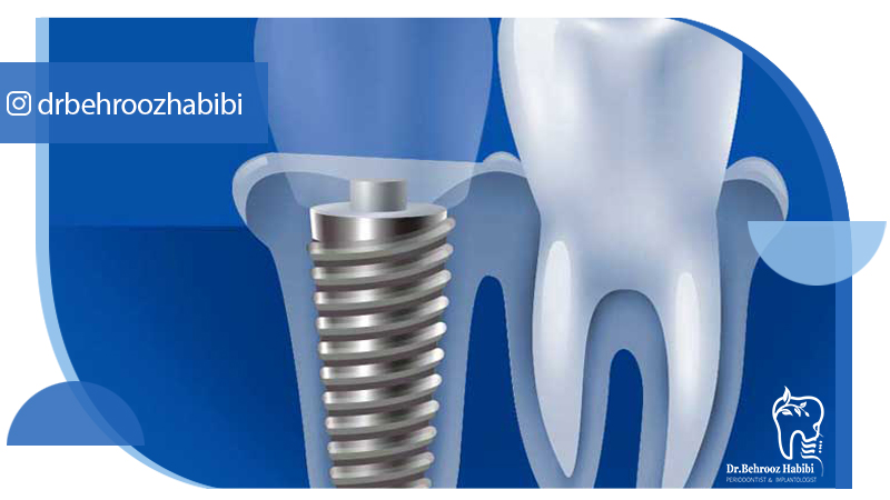 متخصص ایمپلنت تهران | بهترین متخصص ایمپلنت در زعفرانیه تهران