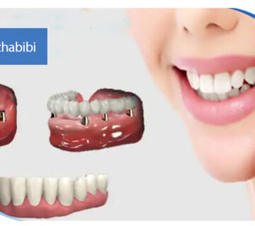 متخصص ایمپلنت تهران | بهترین متخصص ایمپلنت در زعفرانیه تهران