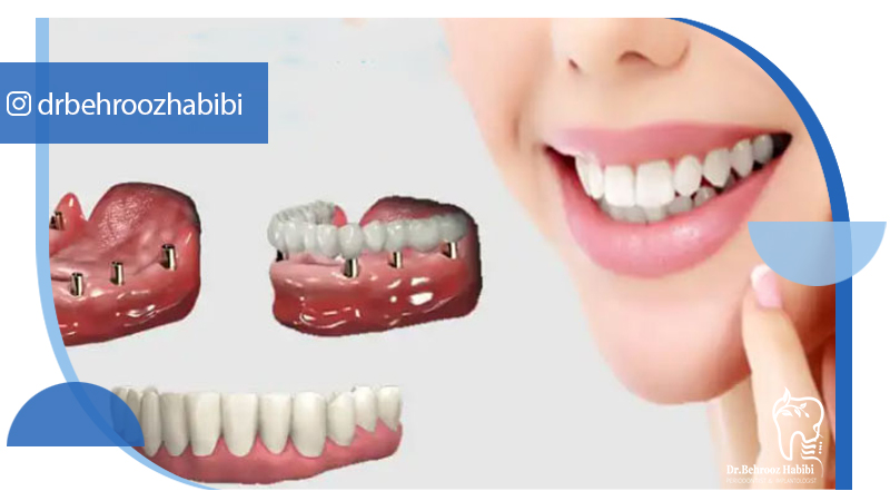 متخصص ایمپلنت تهران | بهترین متخصص ایمپلنت در زعفرانیه تهران