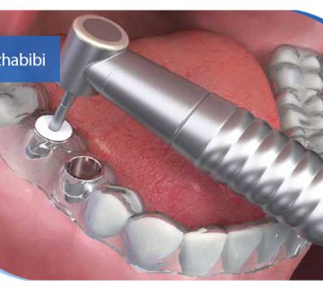 متخصص ایمپلنت تهران | بهترین متخصص ایمپلنت در زعفرانیه تهران | دکتر بهروز حبیبی