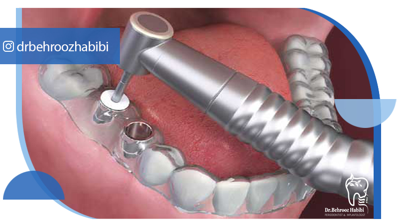 متخصص ایمپلنت تهران | بهترین متخصص ایمپلنت در زعفرانیه تهران | دکتر بهروز حبیبی
