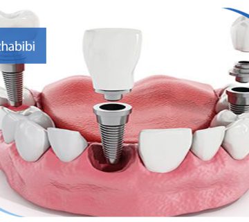 متخصص ایمپلنت تهران | بهترین متخصص ایمپلنت در زعفرانیه تهران | دکتر بهروز حبیبی