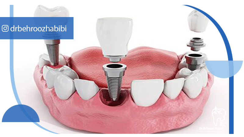 متخصص ایمپلنت تهران | بهترین متخصص ایمپلنت در زعفرانیه تهران | دکتر بهروز حبیبی