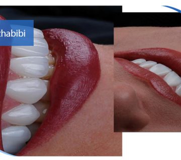 متخصص ایمپلنت تهران | بهترین متخصص ایمپلنت در زعفرانیه تهران | دکتر بهروز حبیبی