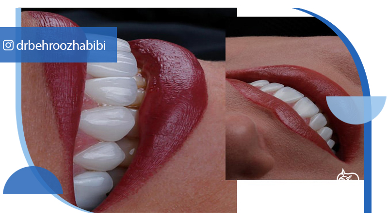 متخصص ایمپلنت تهران | بهترین متخصص ایمپلنت در زعفرانیه تهران | دکتر بهروز حبیبی