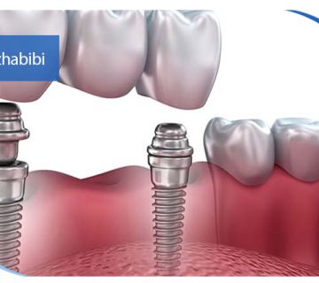 متخصص ایمپلنت تهران | بهترین متخصص ایمپلنت در زعفرانیه تهران | دکتر بهروز حبیبی