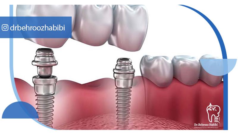 متخصص ایمپلنت تهران | بهترین متخصص ایمپلنت در زعفرانیه تهران | دکتر بهروز حبیبی