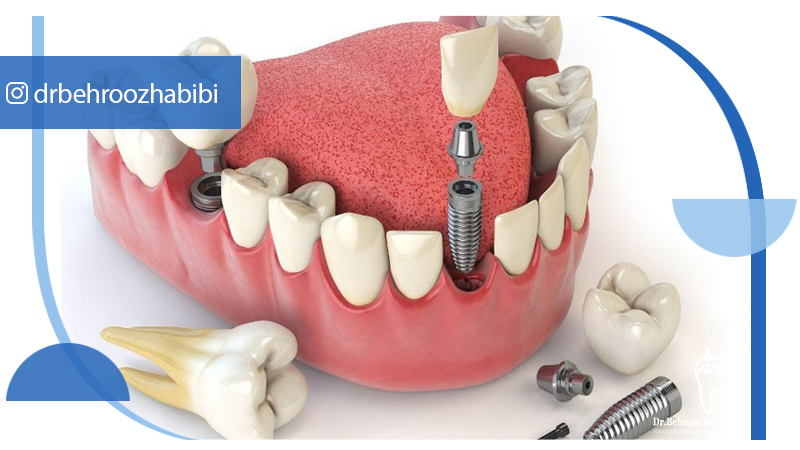 متخصص ایمپلنت تهران | بهترین متخصص ایمپلنت در زعفرانیه تهران | دکتر بهروز حبیبی