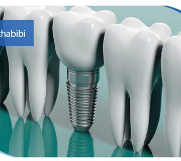 متخصص ایمپلنت تهران | بهترین متخصص ایمپلنت در زعفرانیه تهران | دکتر بهروز حبیبی