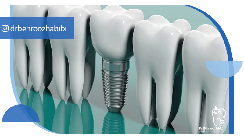 متخصص ایمپلنت تهران | بهترین متخصص ایمپلنت در زعفرانیه تهران | دکتر بهروز حبیبی