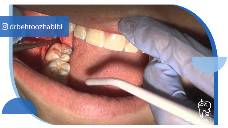 متخصص ایمپلنت تهران | بهترین متخصص ایمپلنت در زعفرانیه تهران | دکتر بهروز حبیبی