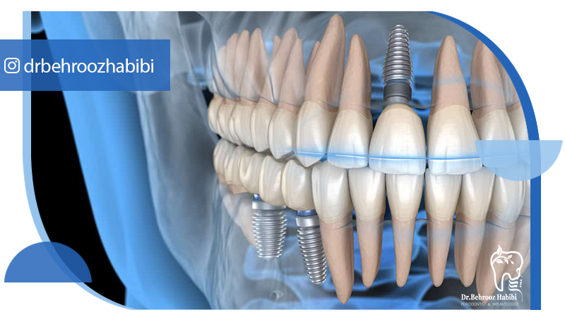 متخصص ایمپلنت تهران | بهترین متخصص ایمپلنت در زعفرانیه تهران | دکتر بهروز حبیبی