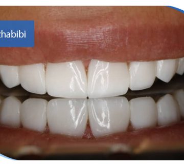 متخصص ایمپلنت تهران | بهترین متخصص ایمپلنت در زعفرانیه تهران | دکتر بهروز حبیبی