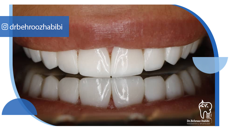 متخصص ایمپلنت تهران | بهترین متخصص ایمپلنت در زعفرانیه تهران | دکتر بهروز حبیبی