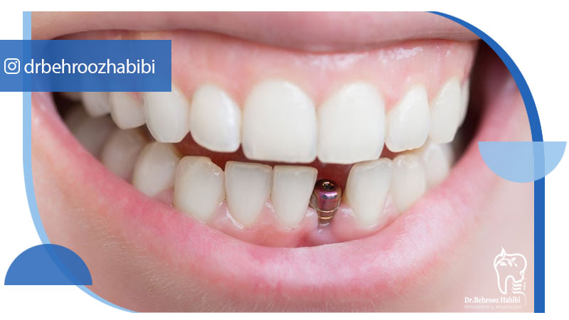 متخصص ایمپلنت و جراحی لثه تهران زعفرانیه