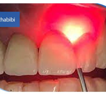 جراحی لثه با لیزر درتهران