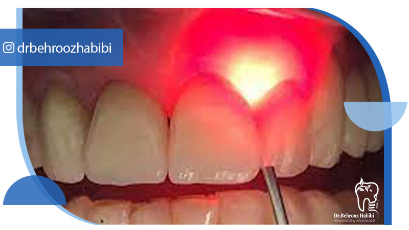 جراحی لثه با لیزر درتهران
