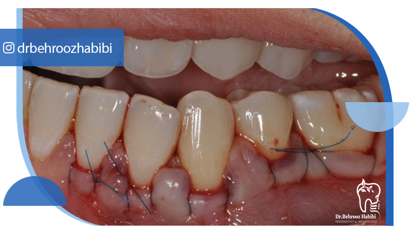 جراحی لثه در زعفرانیه